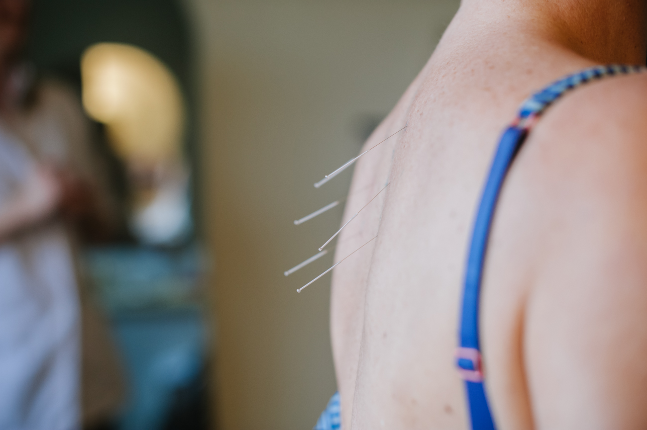 Acupuncture Treatment